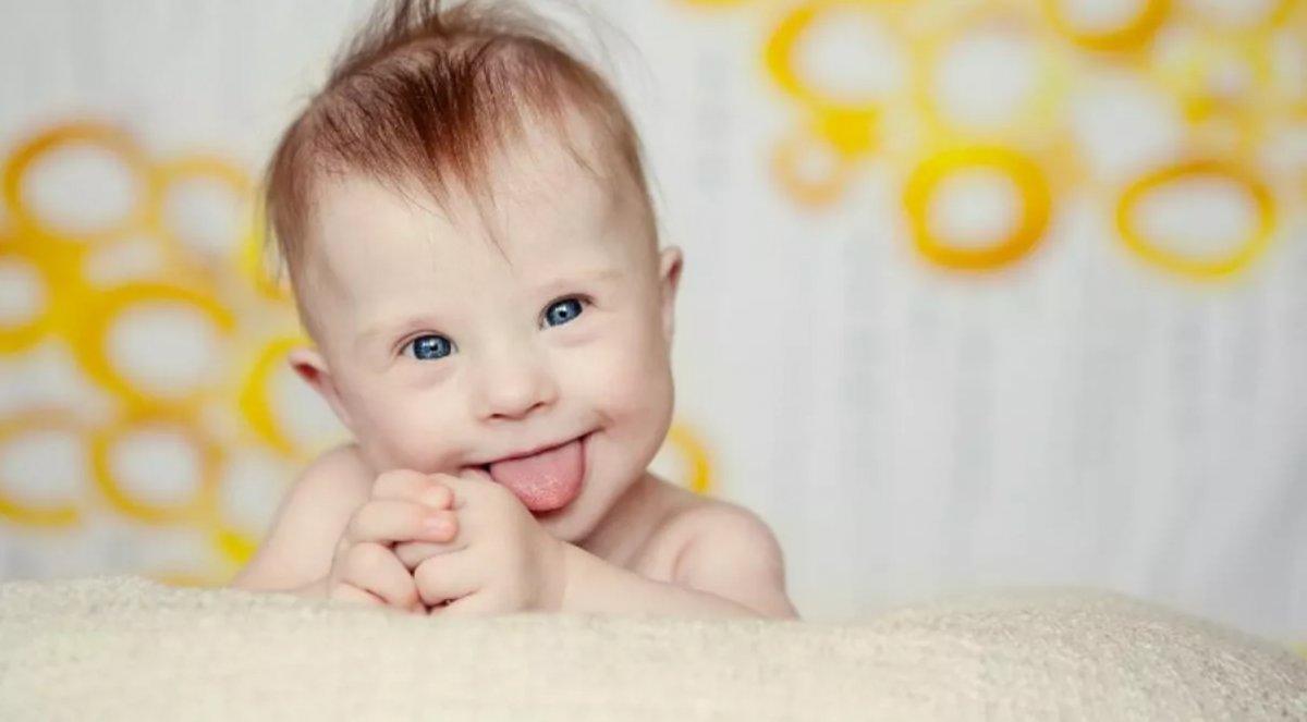 Down sendromu, çocuklarda göz sağlığını etkiliyor