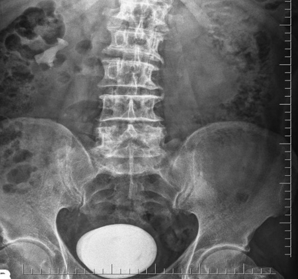 Ordu'da bir hastanın mesanesinden patates büyüklüğünde taş çıkarıldı