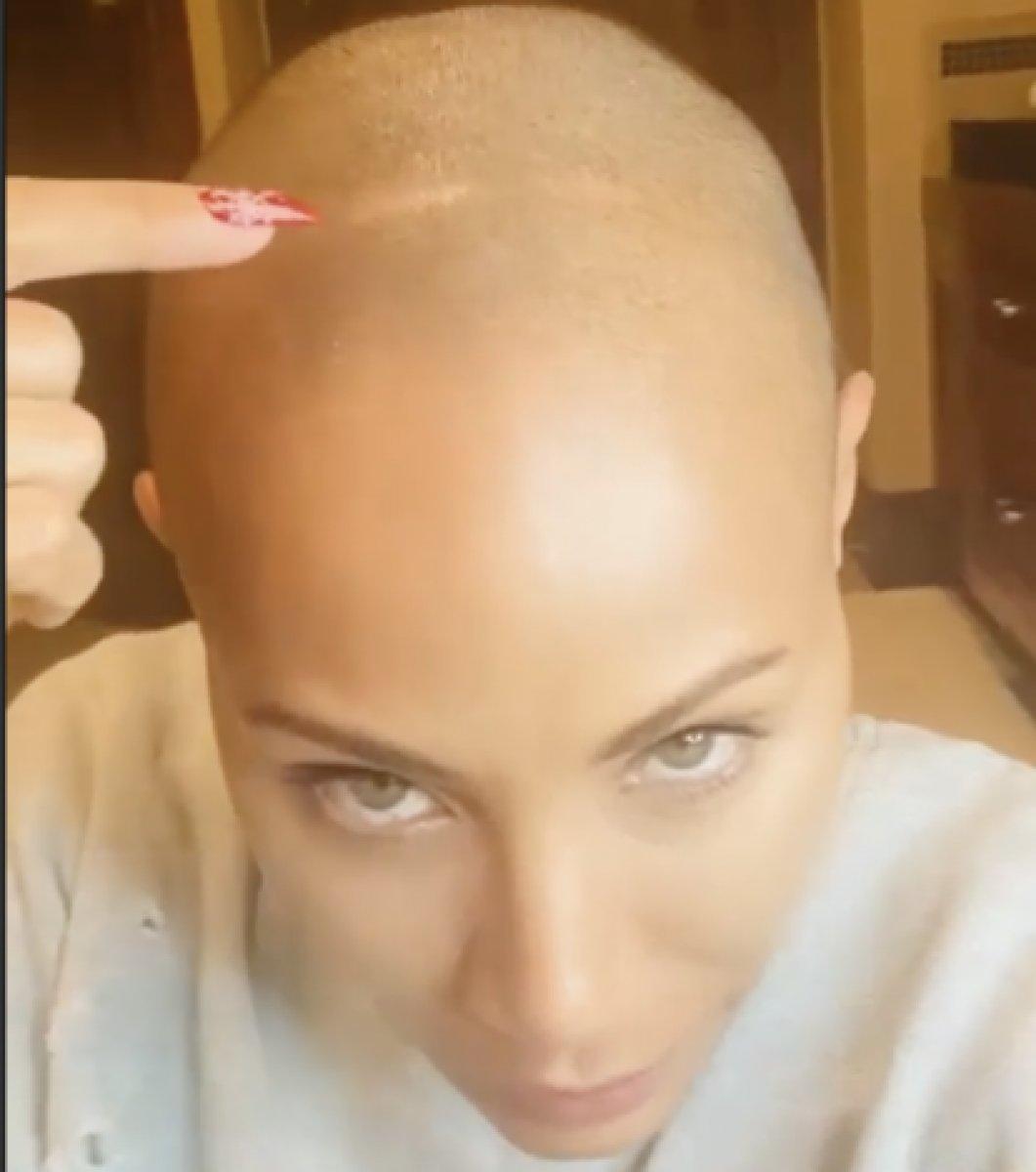 Will Smith'in eşi Jada Smith'in hastalığı: Alopesi nedir