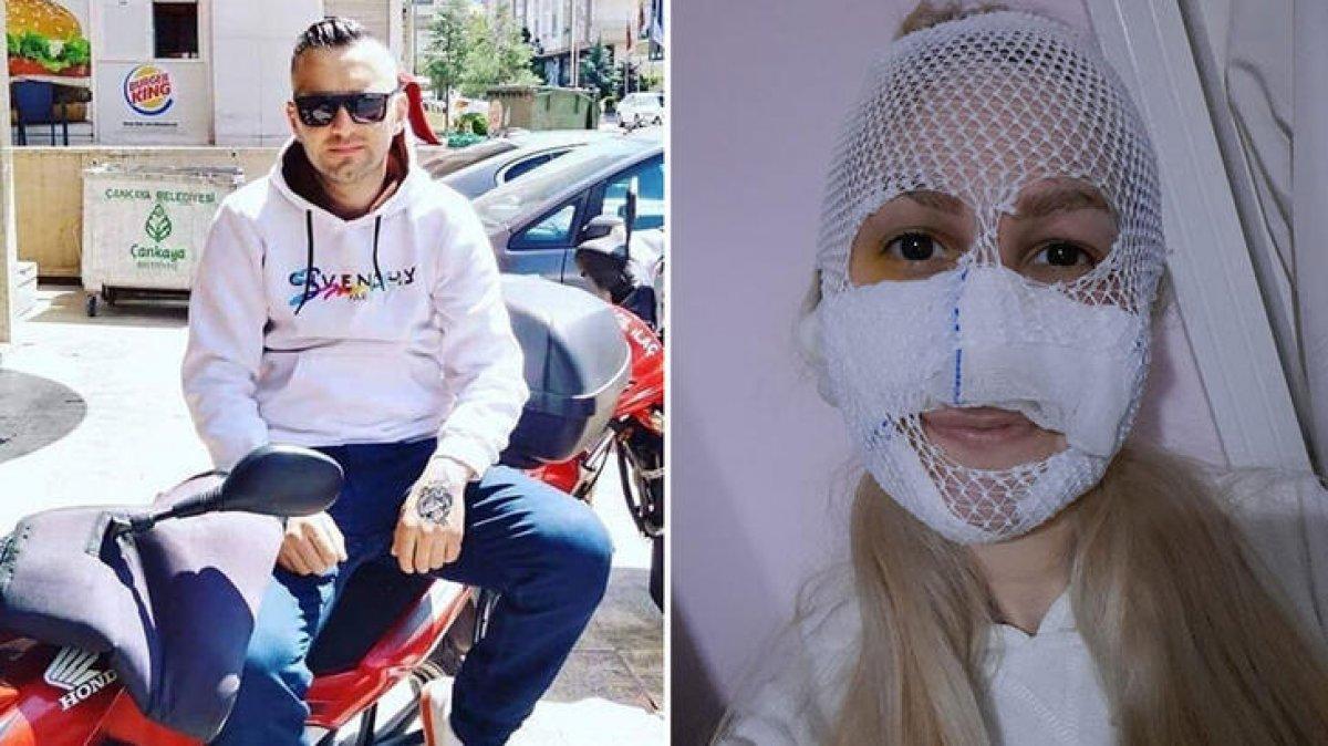 Ankara'da Sultan'ın yüzüne kimyasal madde atan şahıs yakalandı