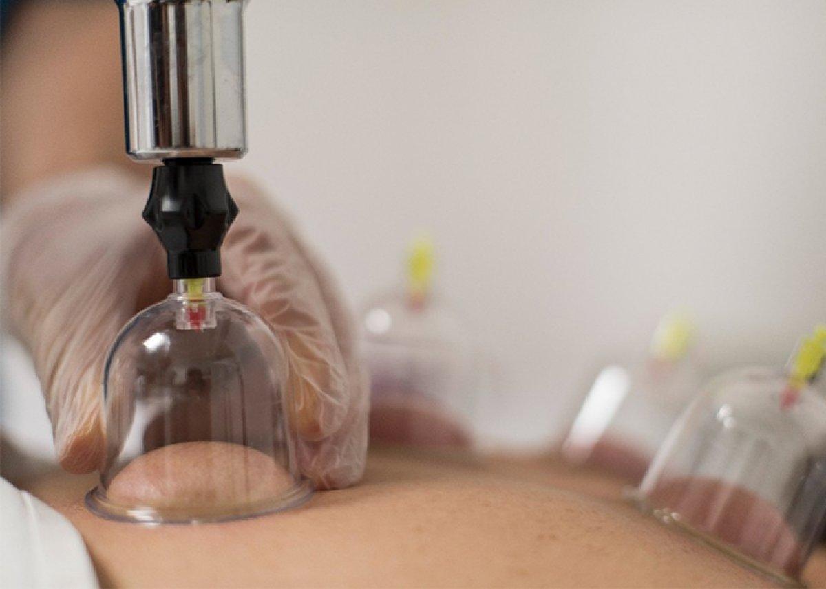 Hacamat günleri Nisan 2022: Ramazan'da hacamat yapılır mı, orucu bozar mı?