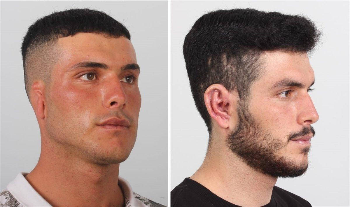 Karaman'da göğüs kafesi dokusundan kulak yapıldı