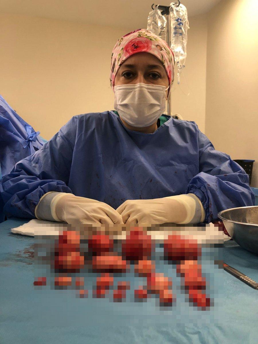 Bursa’da, kadının rahminden 21 miyom çıktı