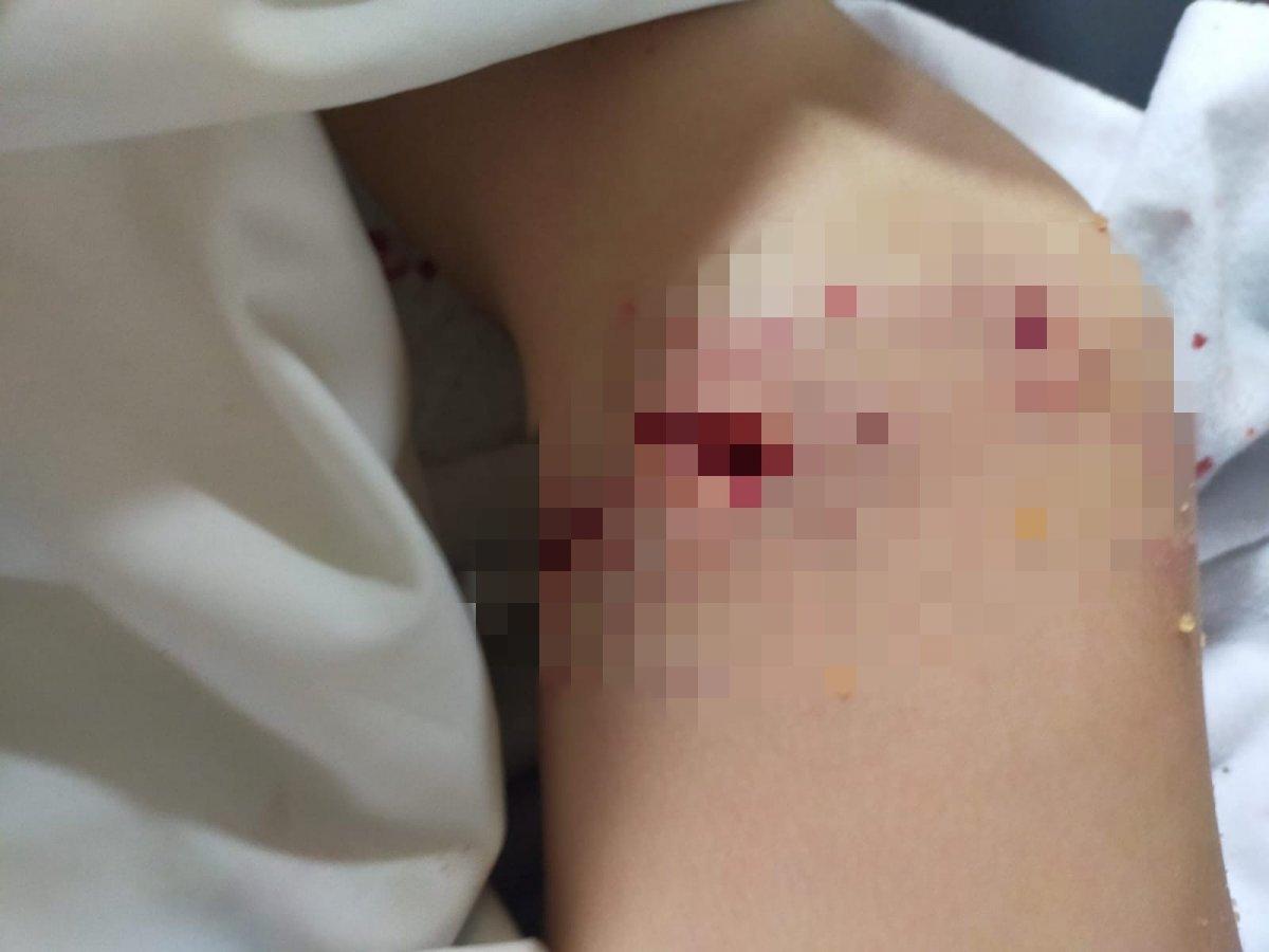 Bursa'da 8 köpeğin saldırısına uğrayan çocuğa 80 dikiş atıldı