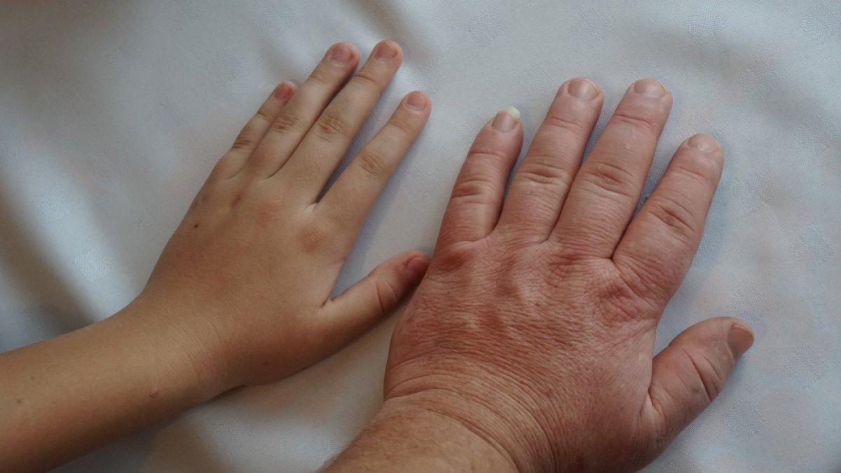 Büyüme hastalığı akromegalide erken tanı, yaşam süresini etkiliyor
