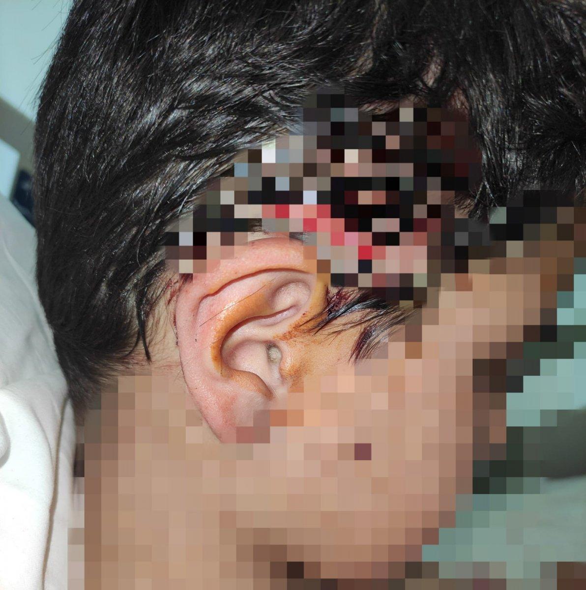 Bursa'da 8 köpeğin saldırısına uğrayan çocuğa 80 dikiş atıldı