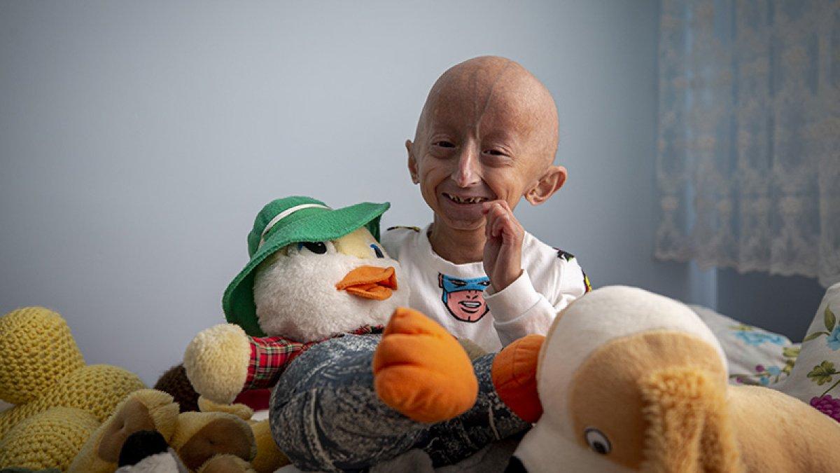 Çok garip ve nadir 10 hastalık