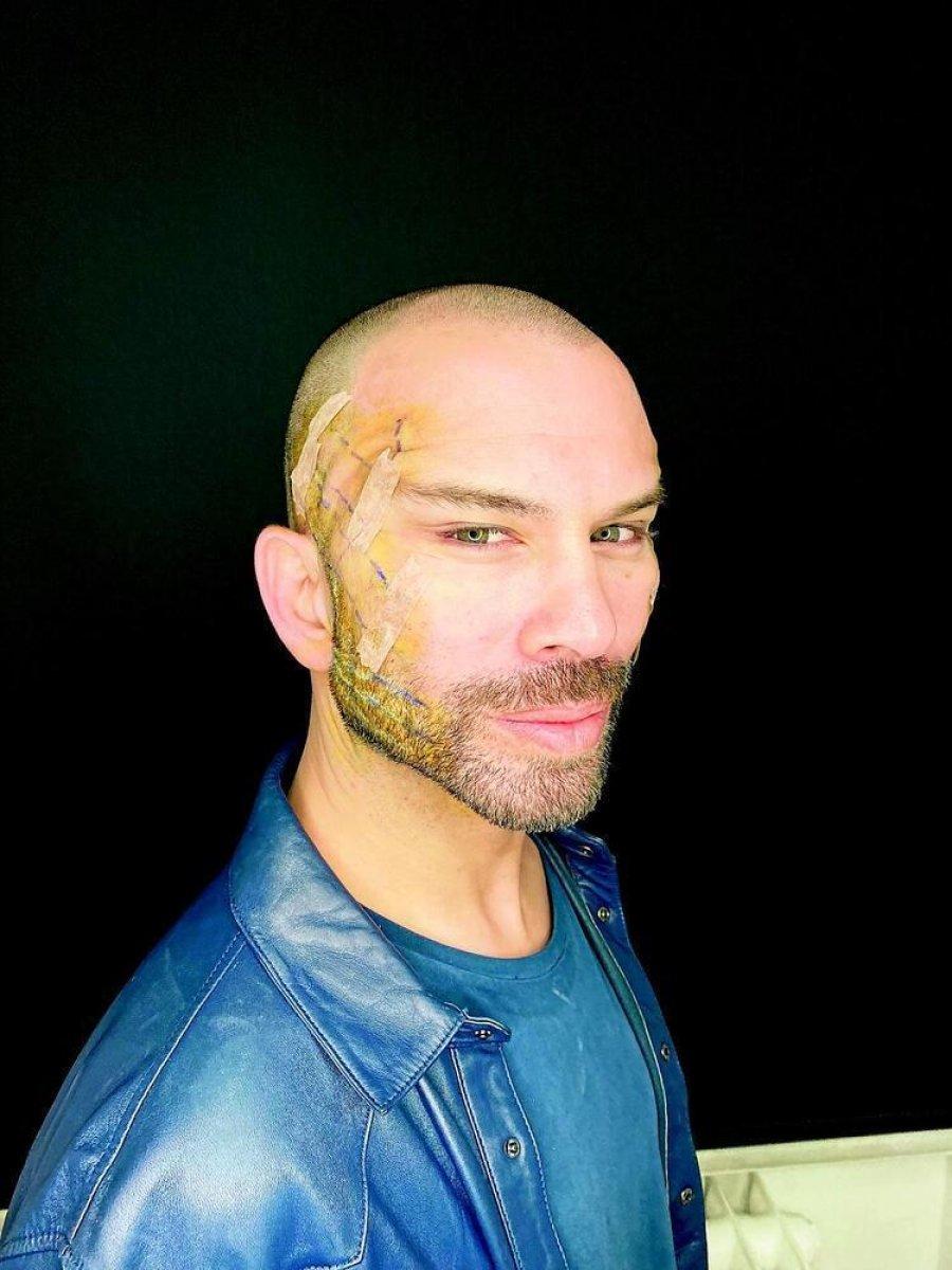 Estetik yaptıran Berksan, ortaya çıktı