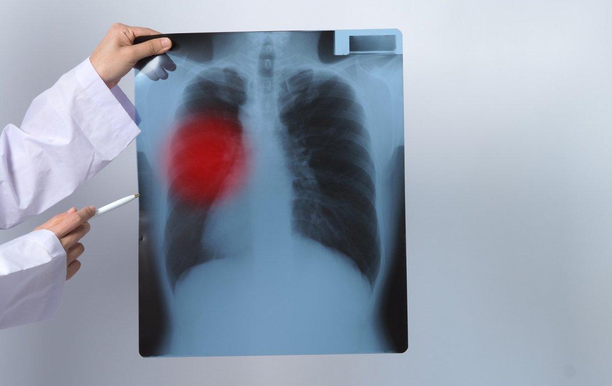 Akciğerleri iyileştiren 12 gıda