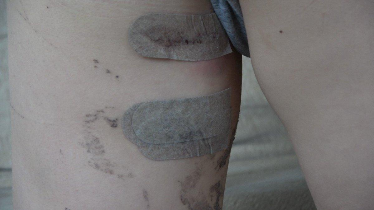 Denizli'de sokak köpekleri minik Tahir'e saldırdı