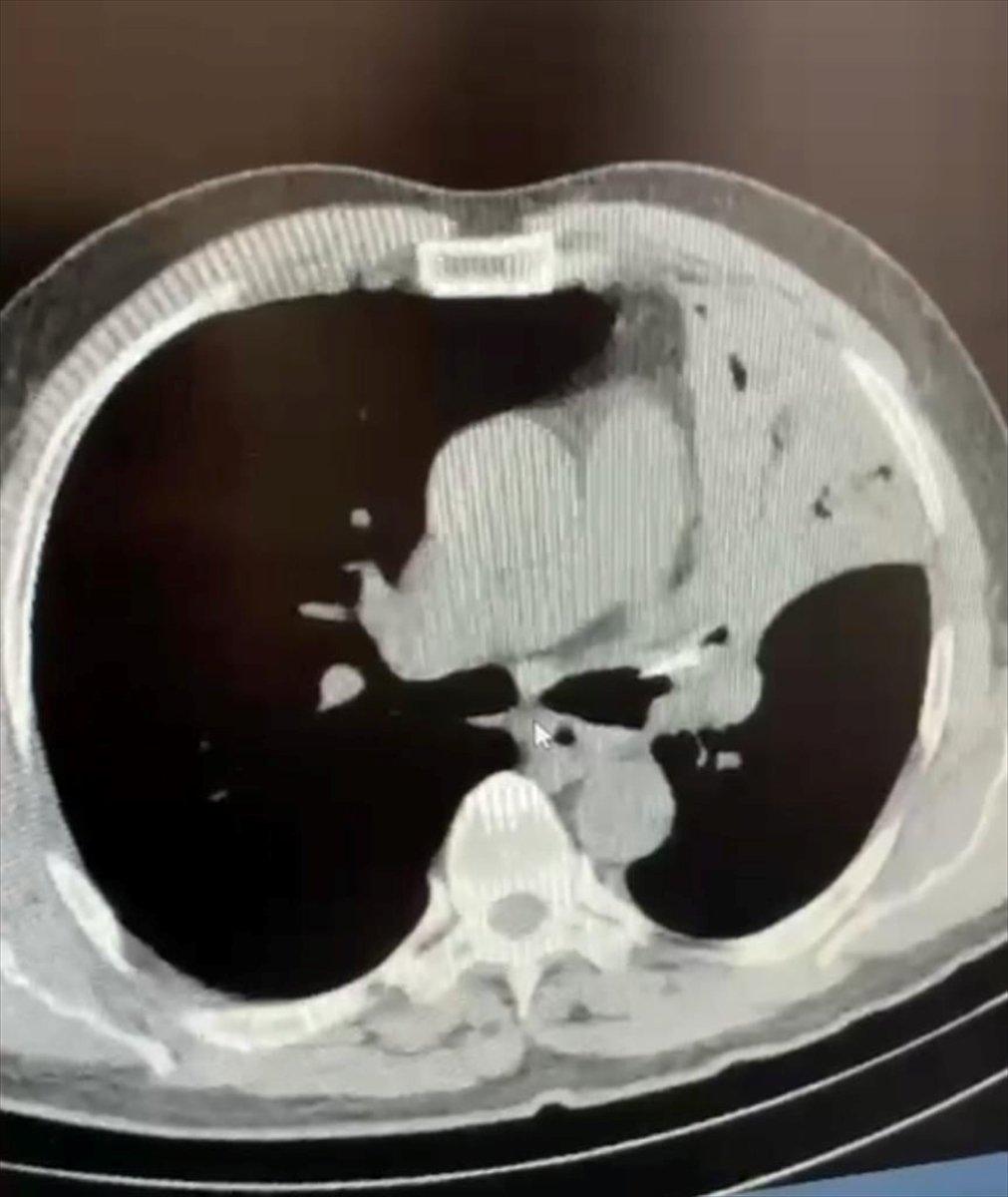 Bolu'da akciğerine saplanan tavuk kemiğinden, 5 yıl sonra kurtuldu