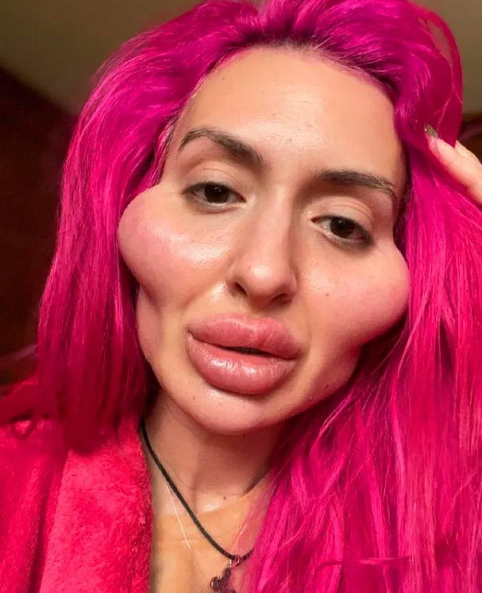 Dünyanın en büyük yanaklısı Anastasia Pokreshchuk dolgu yaptırdı