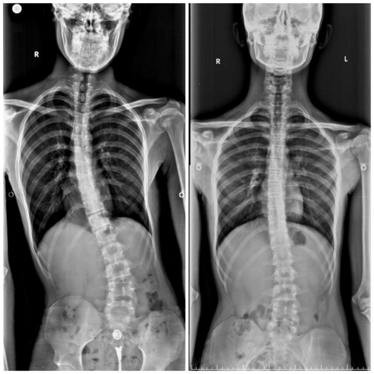 Sakarya'da, bisiklet kazasıyla kemiklerindeki eğriliği fark etti