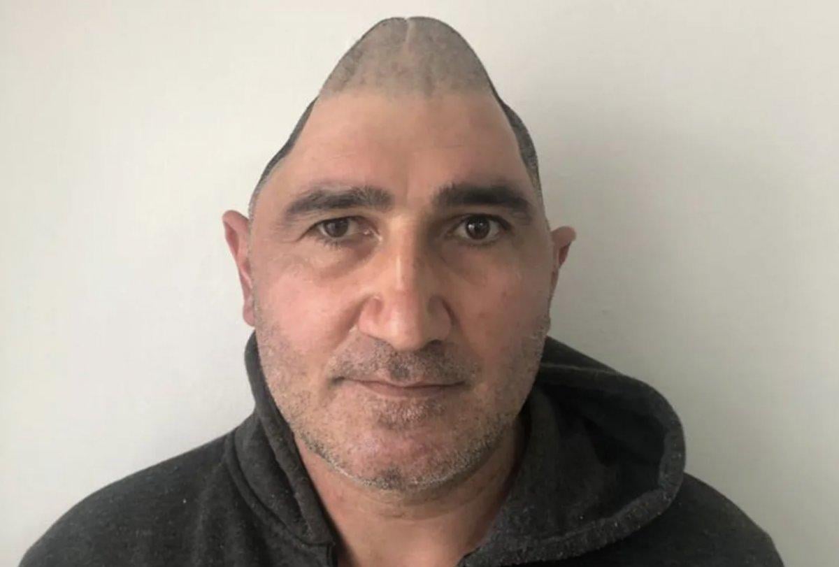 Kafatasının yüzde 83'ü parçalanan adam, yeni görüntüsüne kavuştu