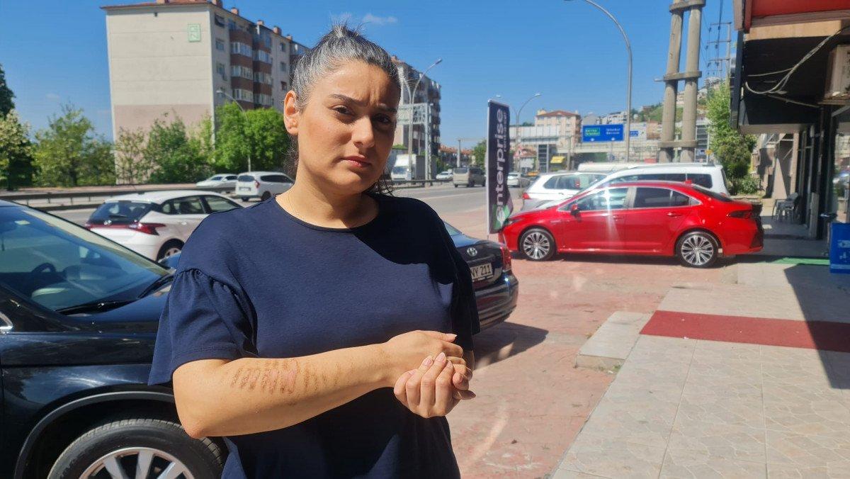 İzmit’te epilasyon sonrası kolları yandı