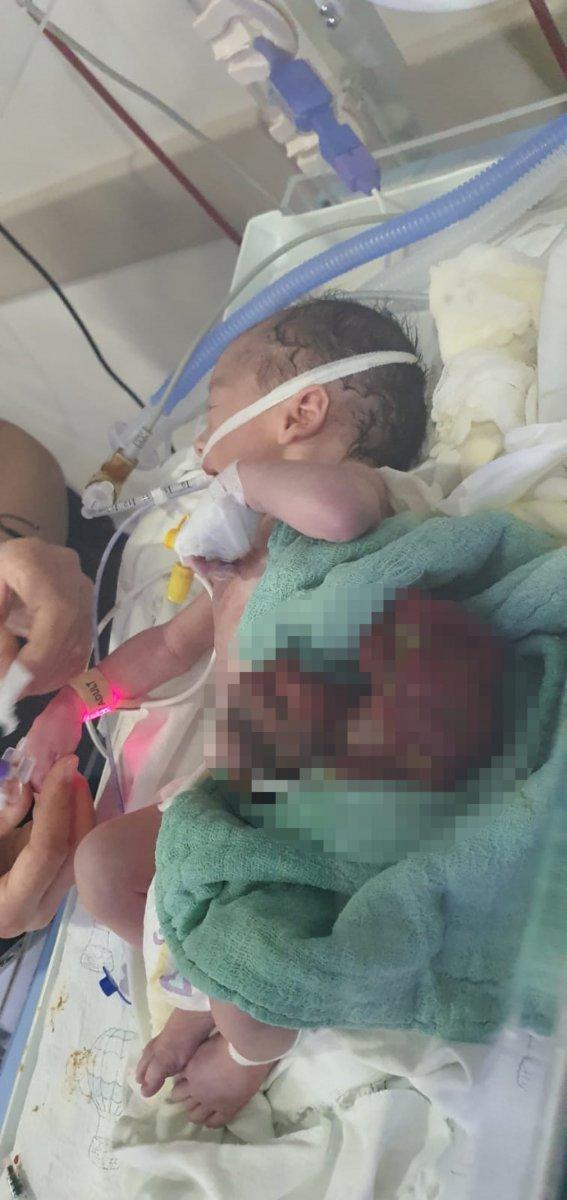 Elazığ'da, bağırsakları dışarıda doğan bebek ameliyatla sağlığına kavuştu