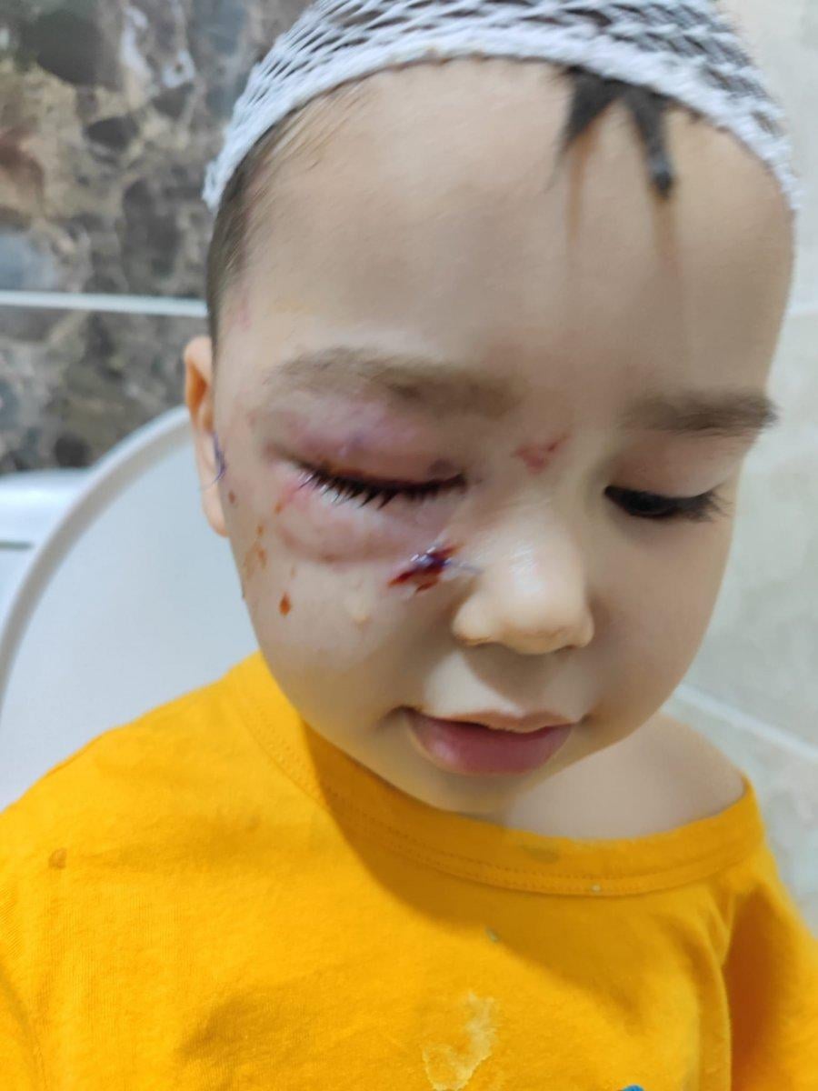 Adana'da güzellik yarışmasına katılan köpek, küçük çocuğun yüzünü parçaladı