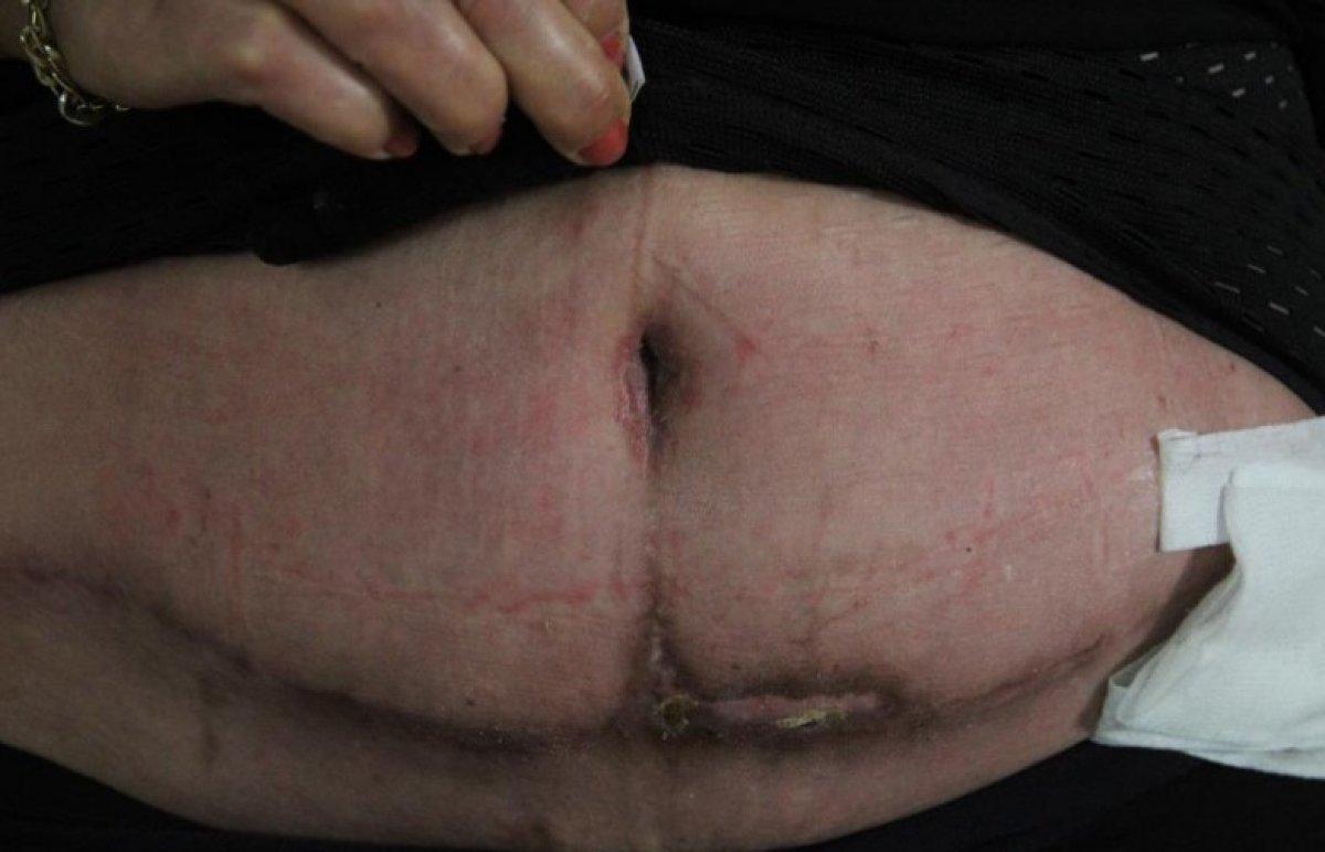 Antalya'da bir kadın estetik mağduru oldu