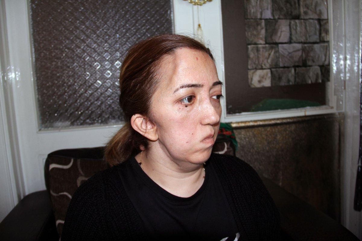 Giresunlu hemşire ameliyat sonrası felç geçirdi, kafatası kayboldu