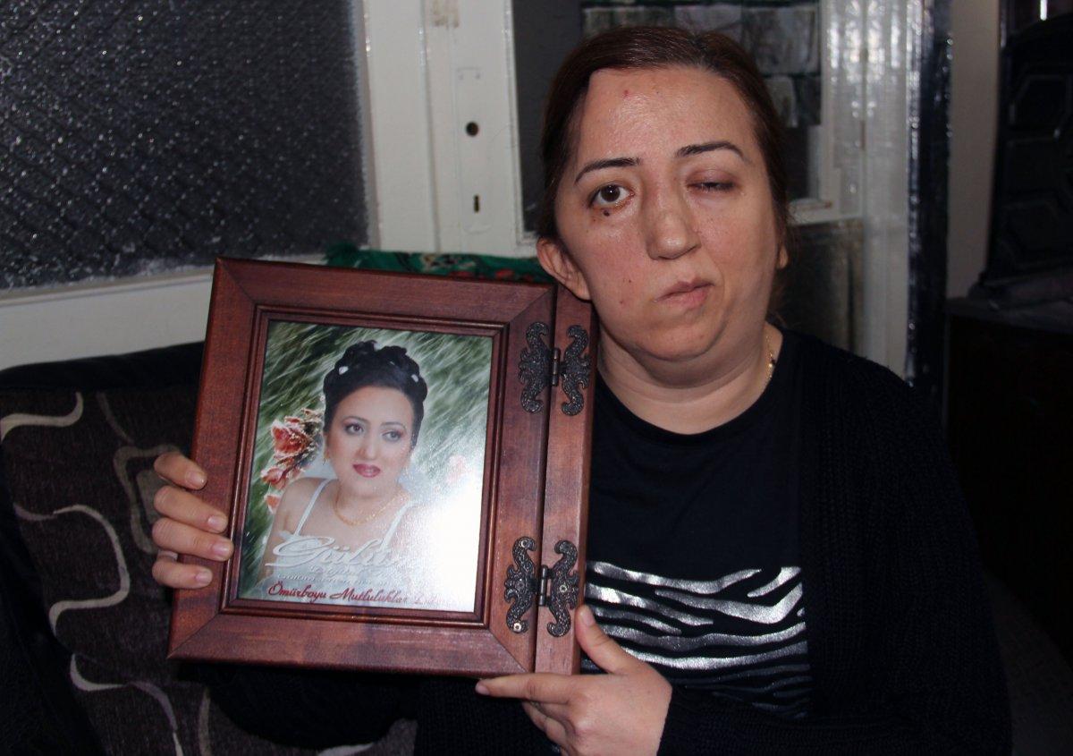 Giresunlu hemşire ameliyat sonrası felç geçirdi, kafatası kayboldu