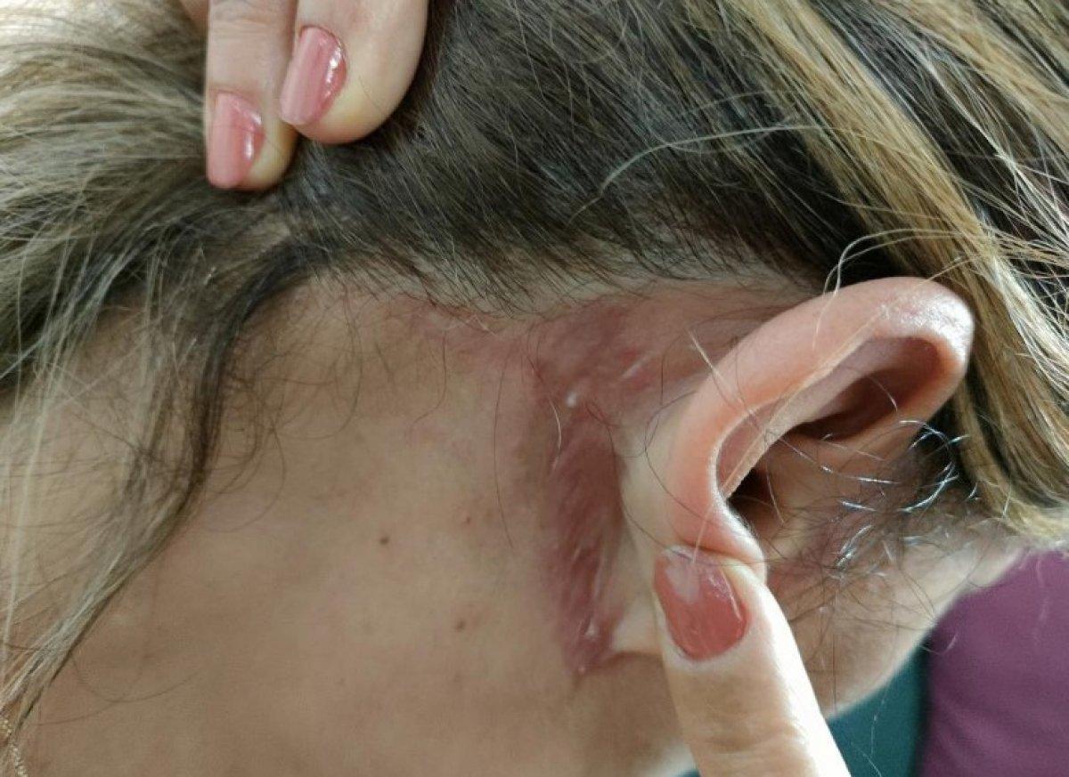 Antalya'da bir kadın estetik mağduru oldu