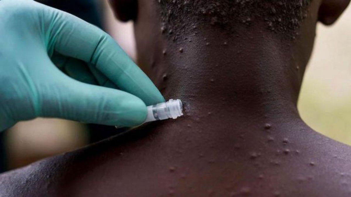 Su çiçeği sanmayın! Maymun çiçeği virüsü nedir, belirtileri nelerdir?