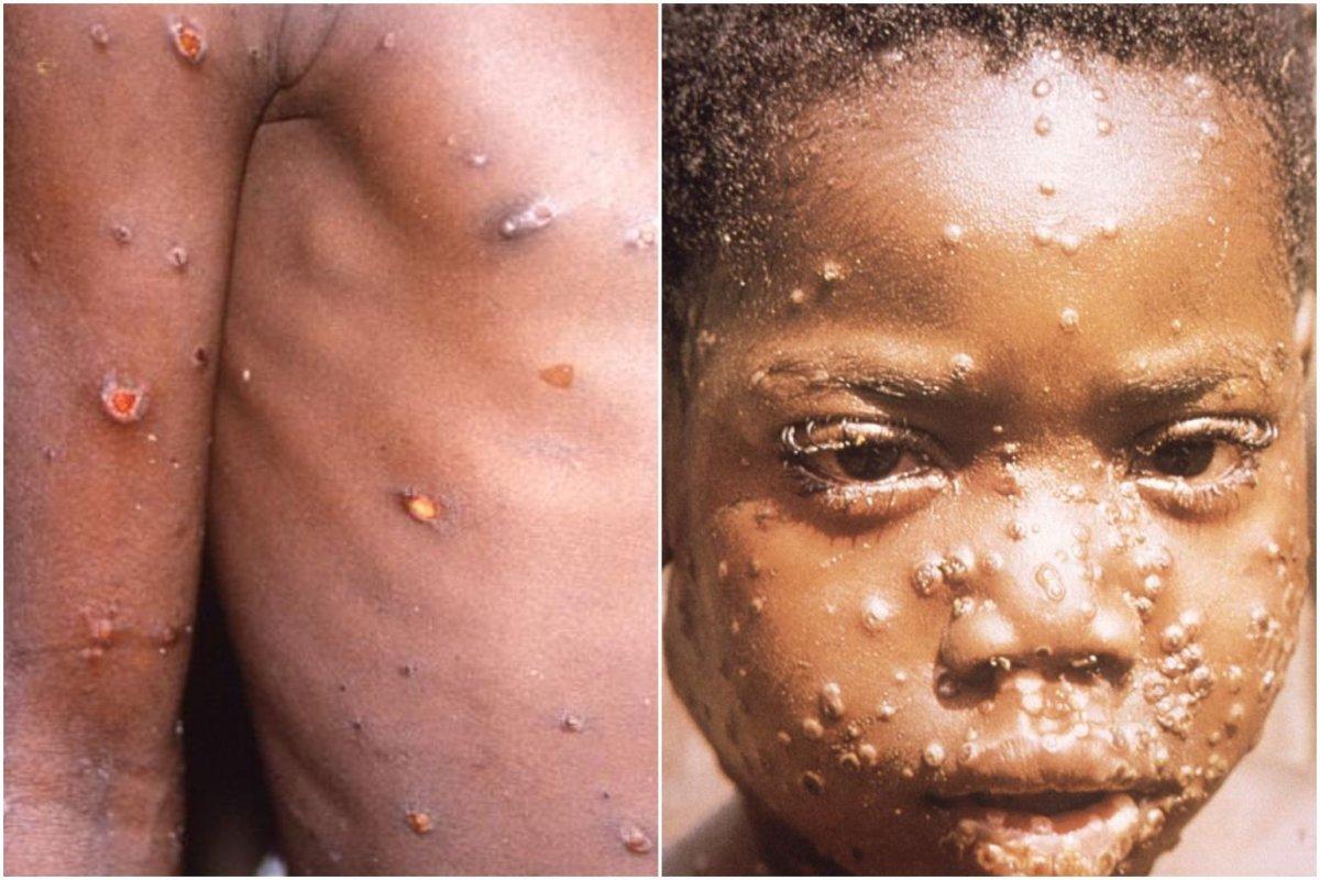 Su çiçeği sanmayın! Maymun çiçeği virüsü nedir, belirtileri nelerdir?