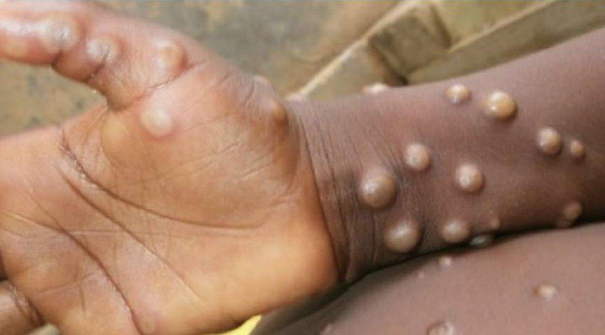 Su çiçeği sanmayın! Maymun çiçeği virüsü nedir, belirtileri nelerdir?