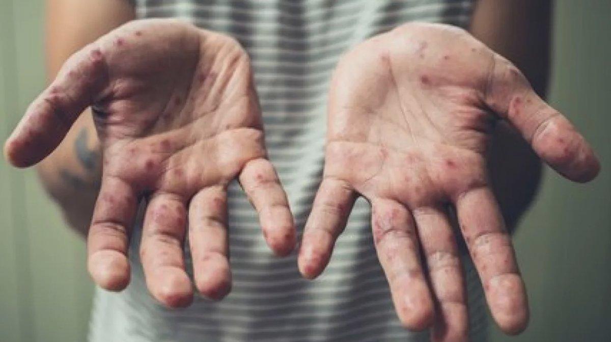 Sağlık Bakanlığı: Ülkemizde maymun çiçeği vakası görülmemiştir