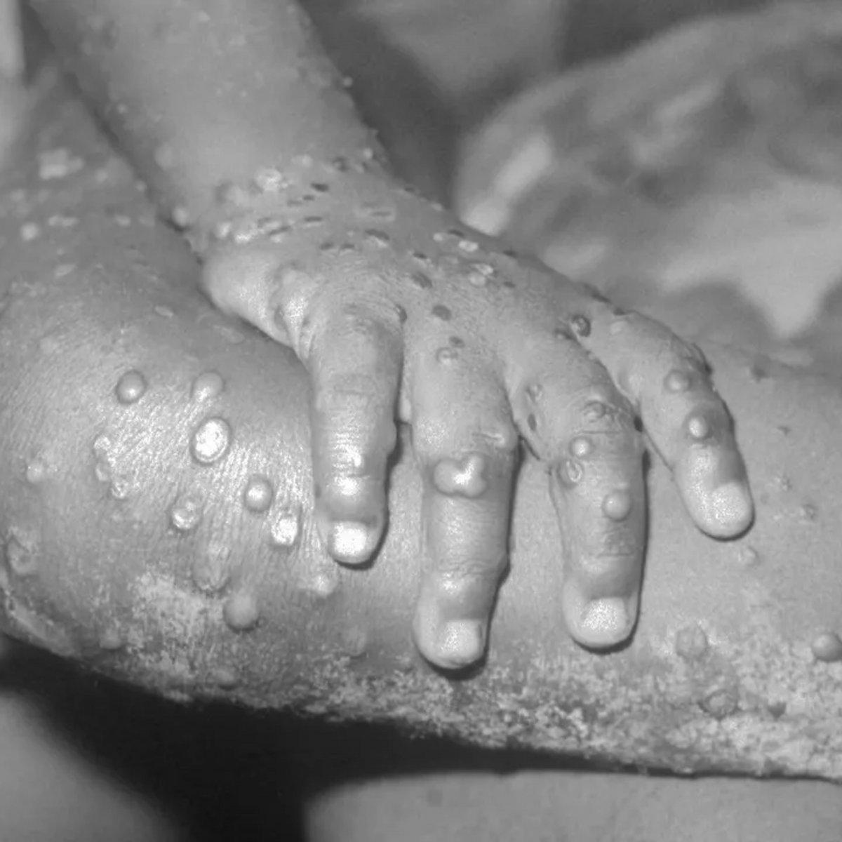 Sağlık Bakanlığı: Ülkemizde maymun çiçeği vakası görülmemiştir