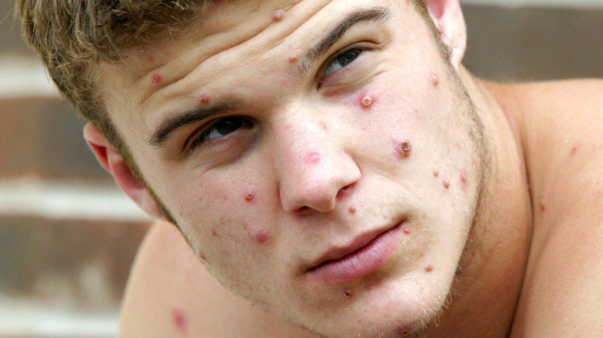 Uzmanlar 10 soruda açıkladı: Maymun çiçeği nedir, ne değildir