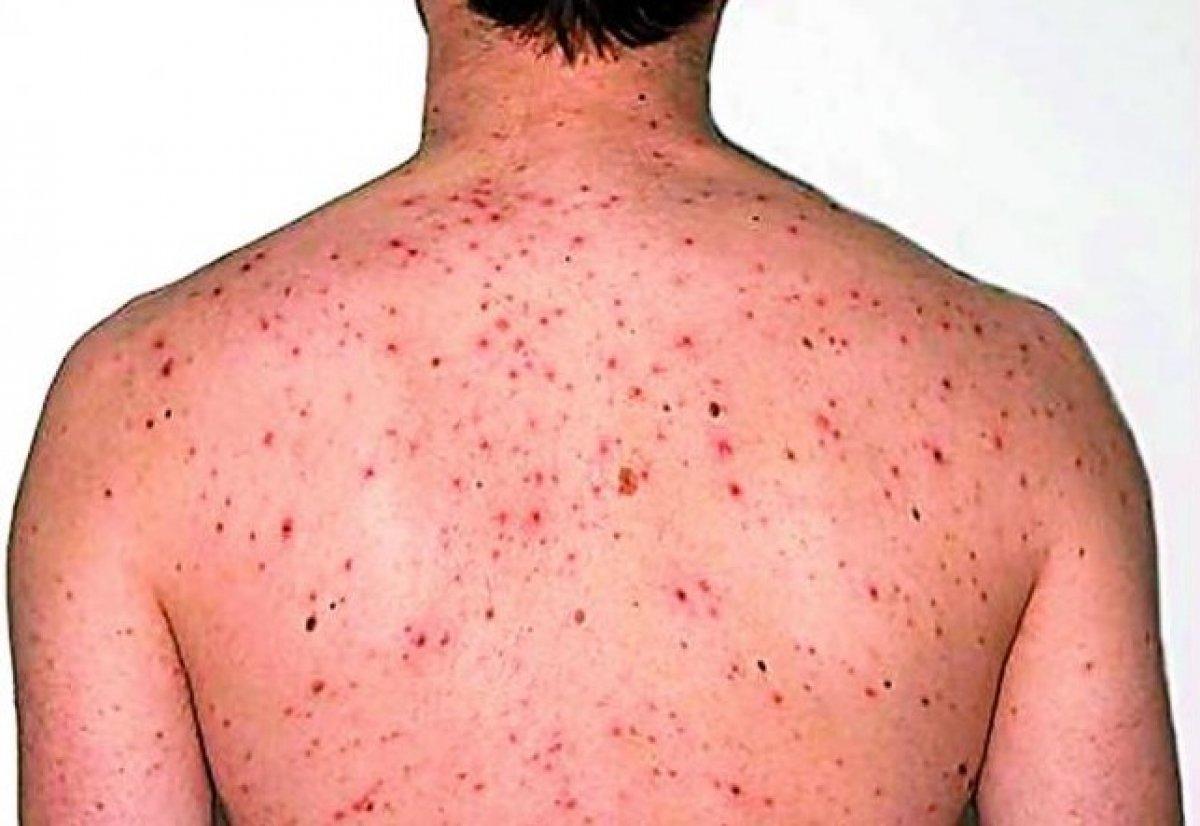 Uzmanlar 10 soruda açıkladı: Maymun çiçeği nedir, ne değildir