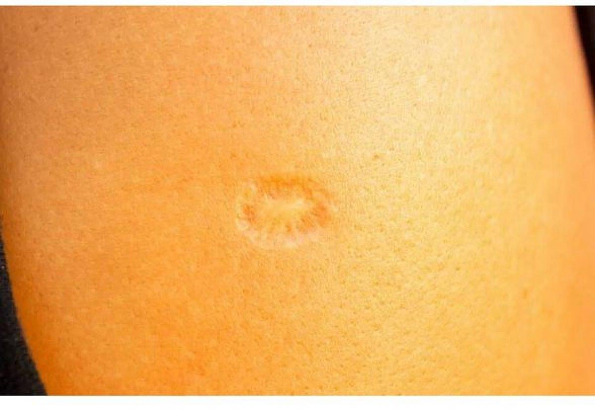 2022 Çiçek aşısı yapılıyor mu, izi nasıl olur? 'Maymun çiçeği'nin çaresi...