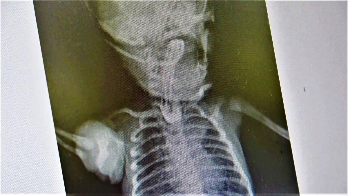 Samsun'da bebeğe, ameliyatla yemek borusu yapıldı