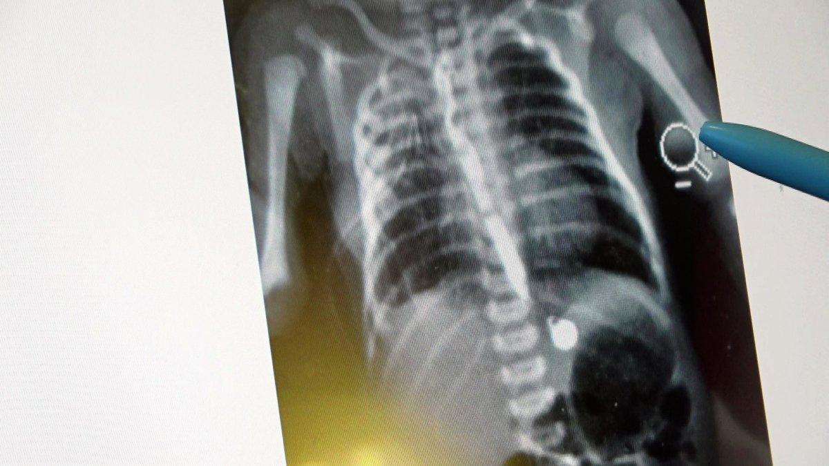 Samsun'da bebeğe, ameliyatla yemek borusu yapıldı