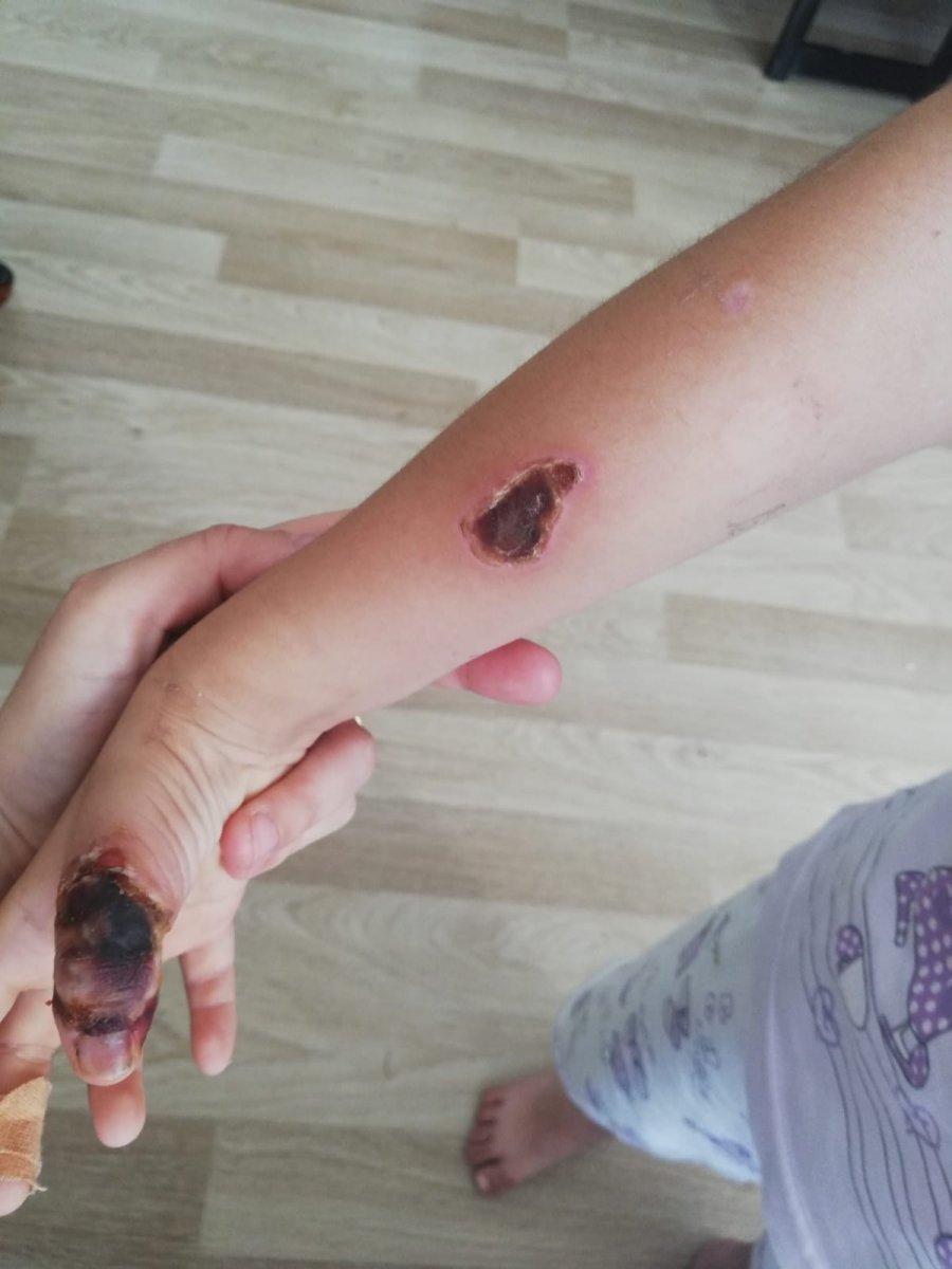 Kadıköy'de MR çekiminde küçük çocuğun eli, kemiğe kadar yandı