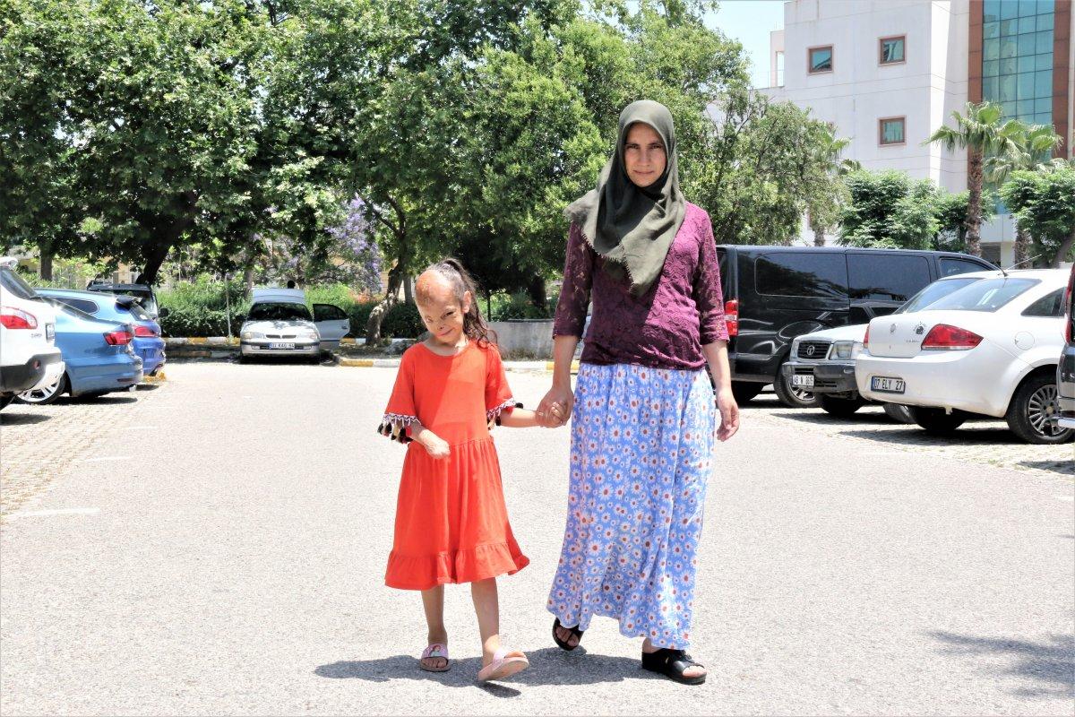 İzmir'de yüzü yanan 6 yaşındaki Dilara'ya, Sağlık Bakanlığı el uzattı