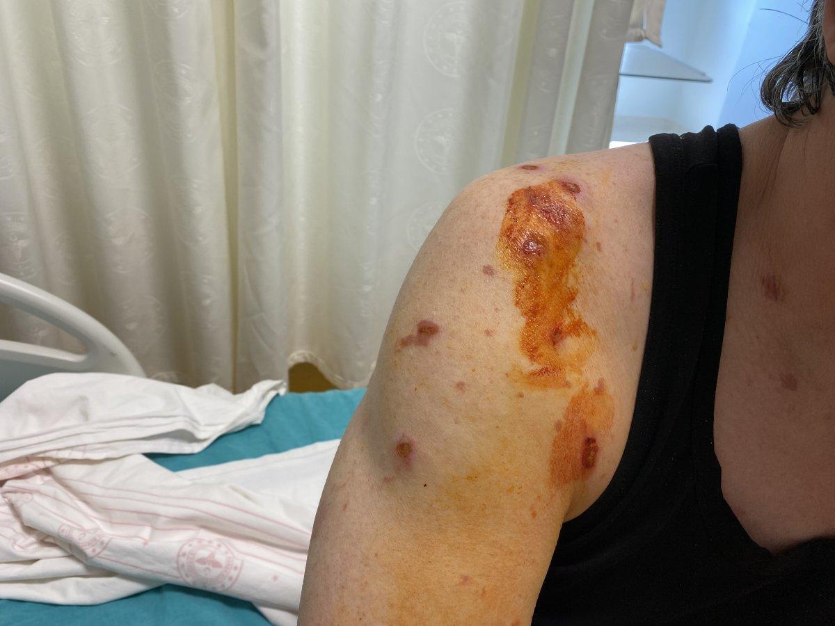 Bahçelievler’de patlayan lavabo açıcı yaraladı