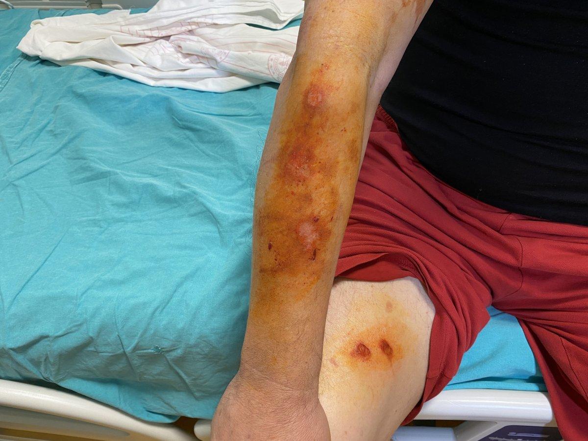 Bahçelievler’de patlayan lavabo açıcı yaraladı