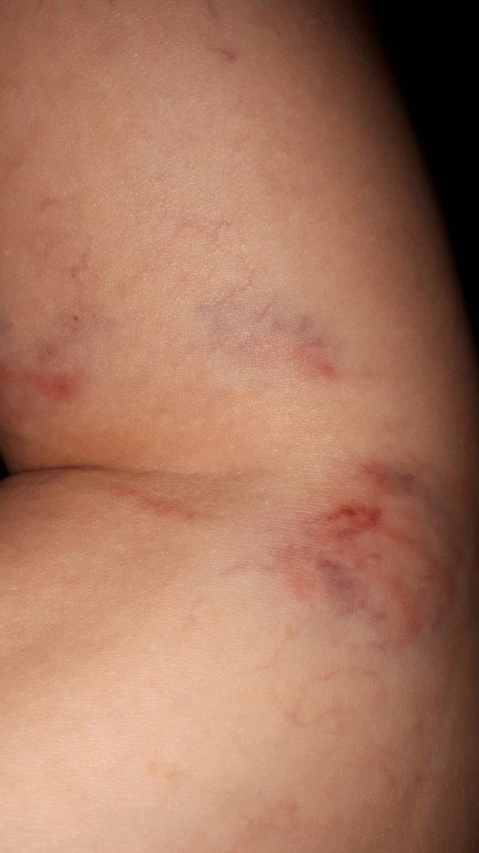 Zonguldak'ta sokak köpekleri genç kadını yaraladı