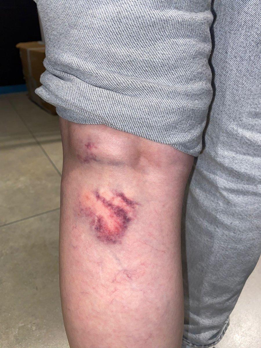 Zonguldak'ta sokak köpekleri genç kadını yaraladı