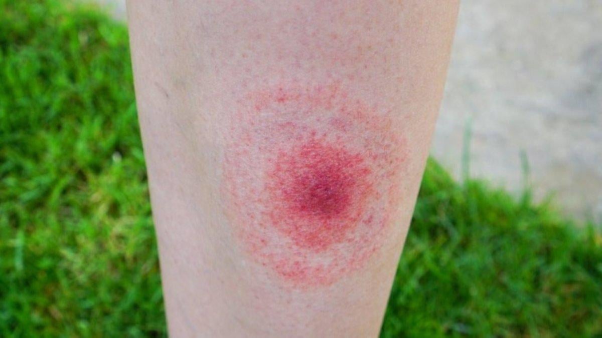 Hayat kurtarır: Mutlaka bilmeniz gereken 10 böcek ısırığı