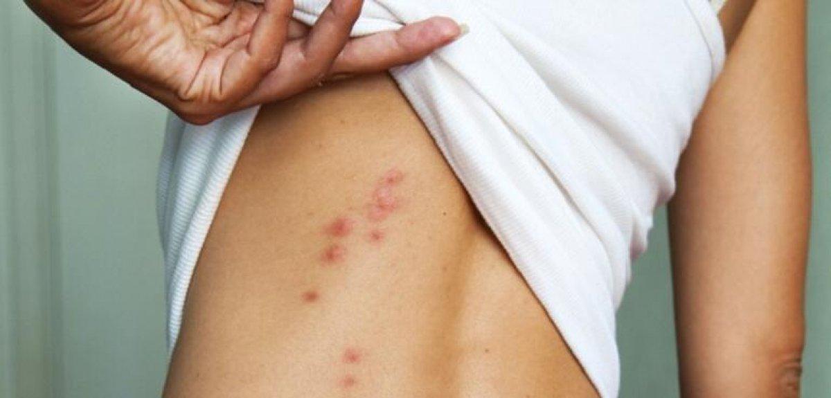 Hayat kurtarır: Mutlaka bilmeniz gereken 10 böcek ısırığı