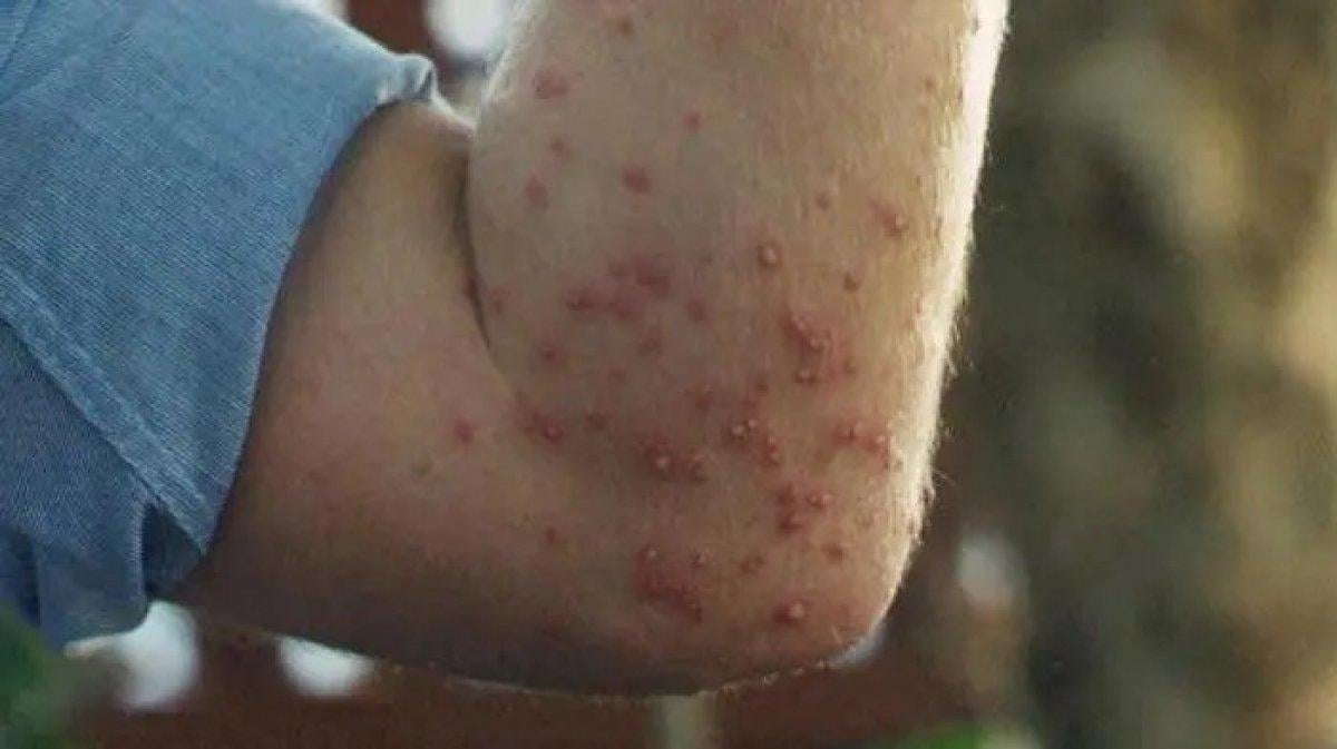 Hayat kurtarır: Mutlaka bilmeniz gereken 10 böcek ısırığı