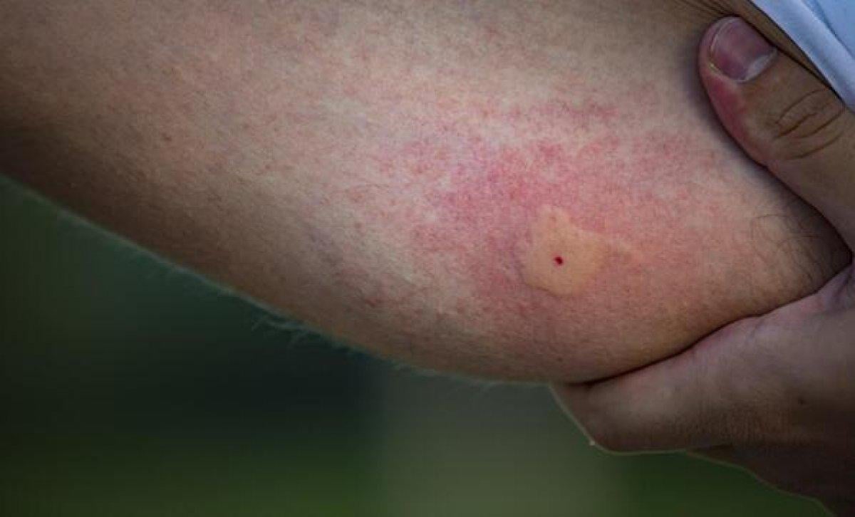 Hayat kurtarır: Mutlaka bilmeniz gereken 10 böcek ısırığı