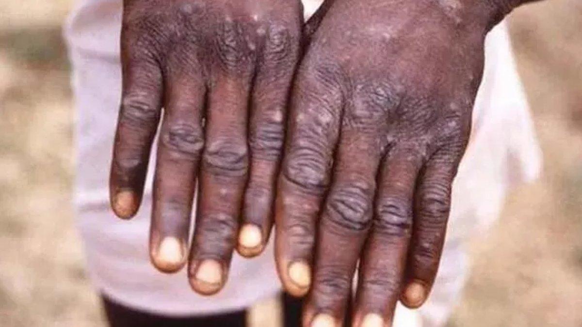 DSÖ'den Afrika'da maymun çiçeği virüsü açıklaması