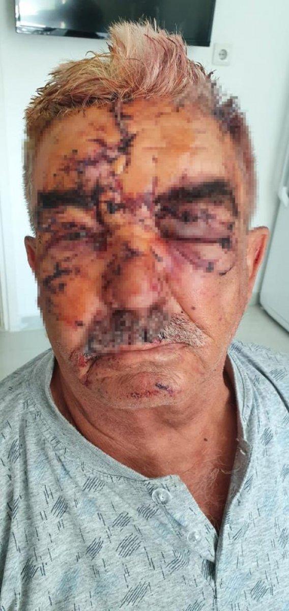 Antalya'da komşusunun köpeği tarafından saldırıya uğradı