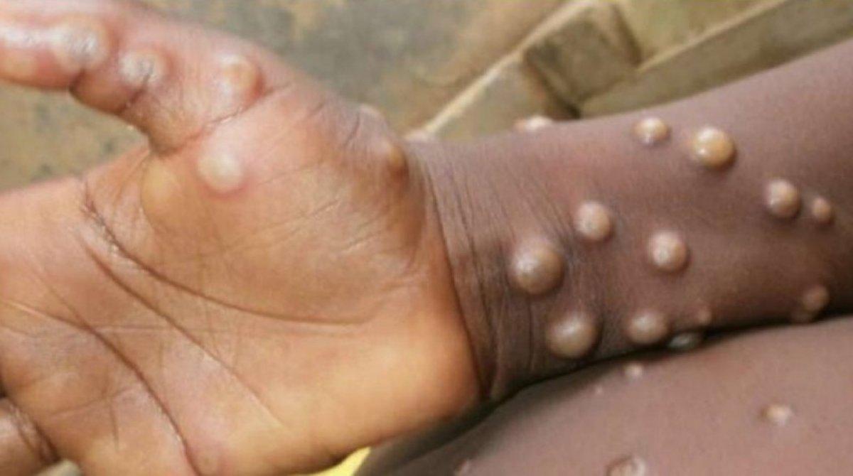 DSÖ: 30 ülkede 550 maymun çiçeği vakası görüldü