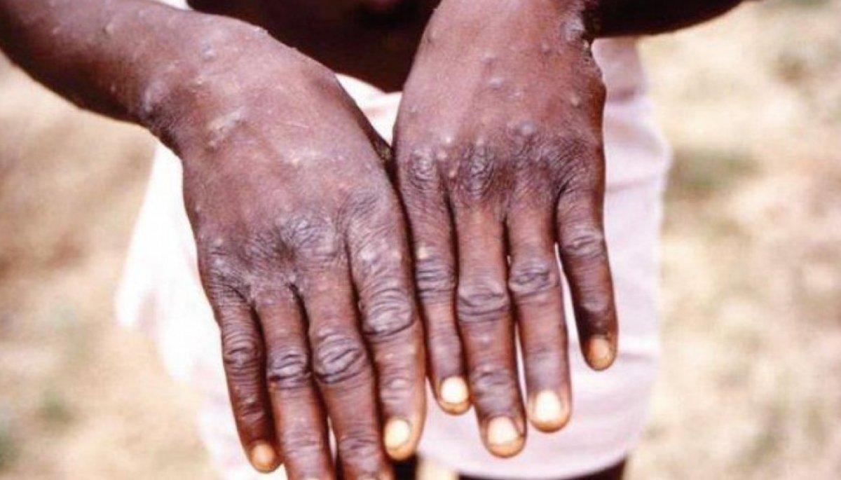 DSÖ: 30 ülkede 550 maymun çiçeği vakası görüldü