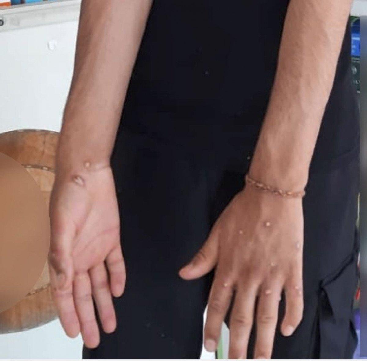 Sultangazi'de maymun çiçeği şüphesi